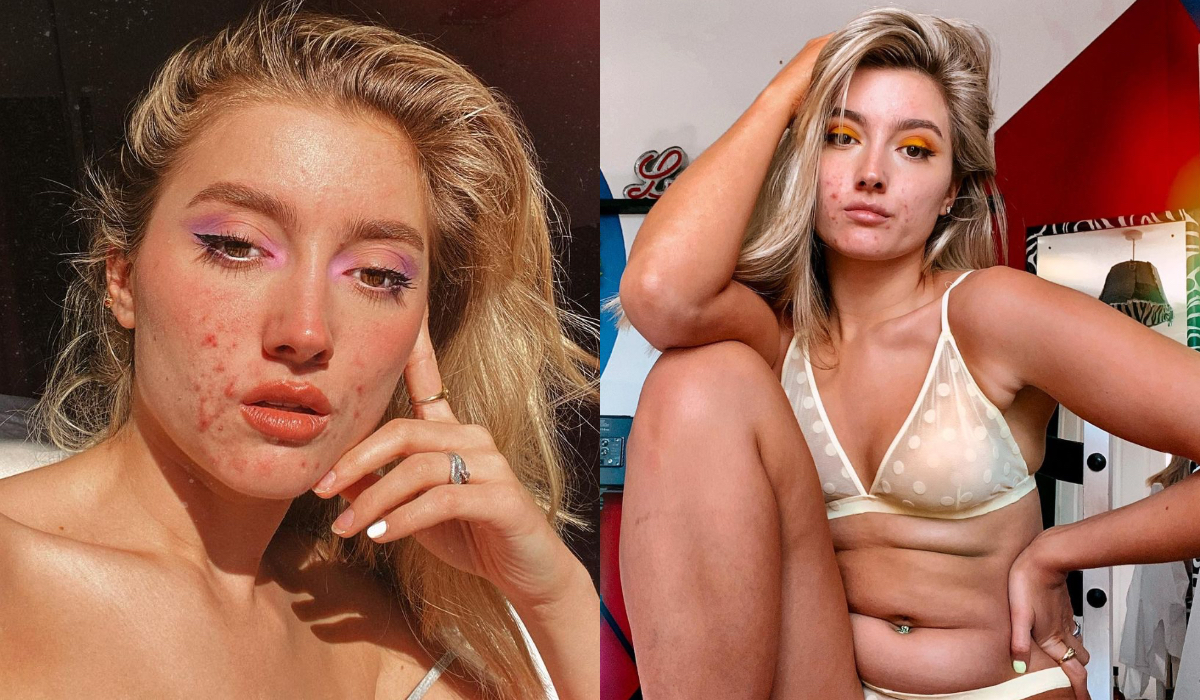 Modelka z trądzikiem reklamuje popularną markę odzieżową